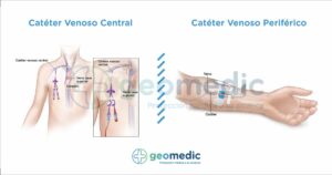 Diferencias entre catéteres venosos centrales y periféricos: ¿Cuál es la mejor opción para tu paciente?